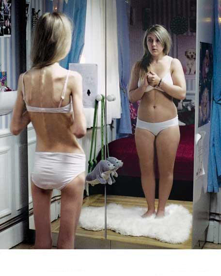 El 15 % de los jóvenes de España sufre bulimia o anorexia